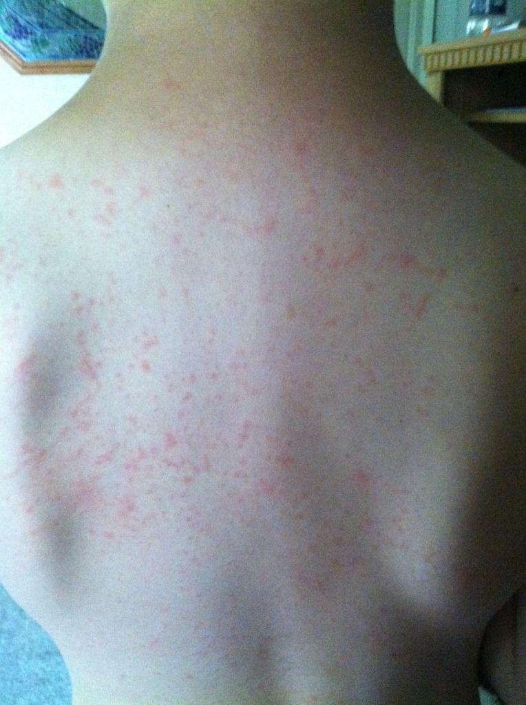 Skin allergy to grass? BabyCenter